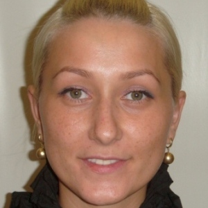 Отопластика – фотография после (пациент)