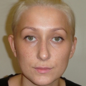 Отопластика – фотография до процедуры (пациент)