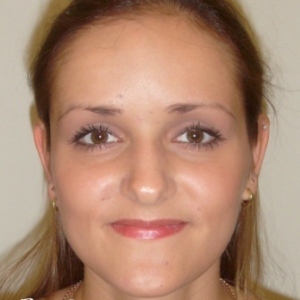 Отопластика – фотография после (пациент)