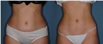 BodyTite