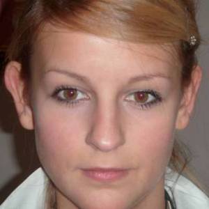 Отопластика – фотография до процедуры (пациент)