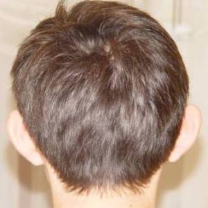 Отопластика – фотография до процедуры (пациент)