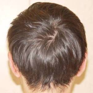 Отопластика – фотография после (пациент)