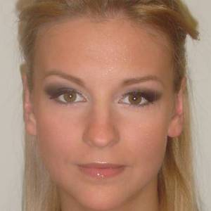 Отопластика – фотография после (пациент)