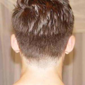 Отопластика – фотография до процедуры (пациент)