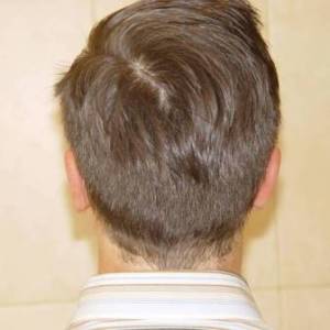 Отопластика – фотография после (пациент)