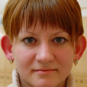 Отопластика – фотография до процедуры (пациент)