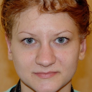 Отопластика – фотография после (пациент)